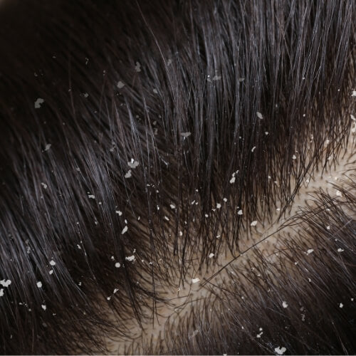 Sensitive scalp / dandruff