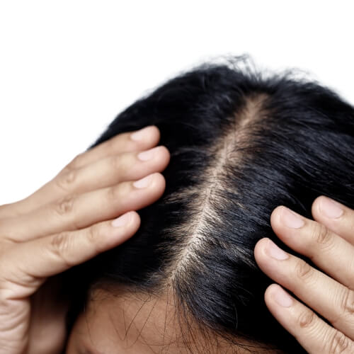 Hair loss / thinning